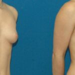 Breast Implant #12 - Before and After