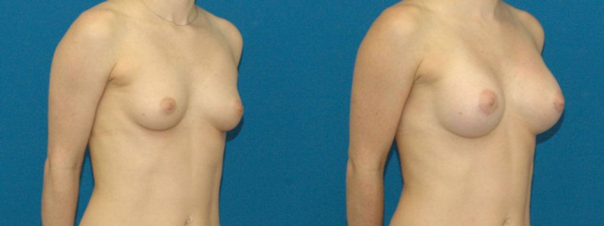 Breast Implant #12 - Before and After
