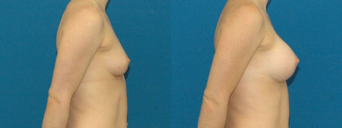 Breast Implant #12 - Before and After