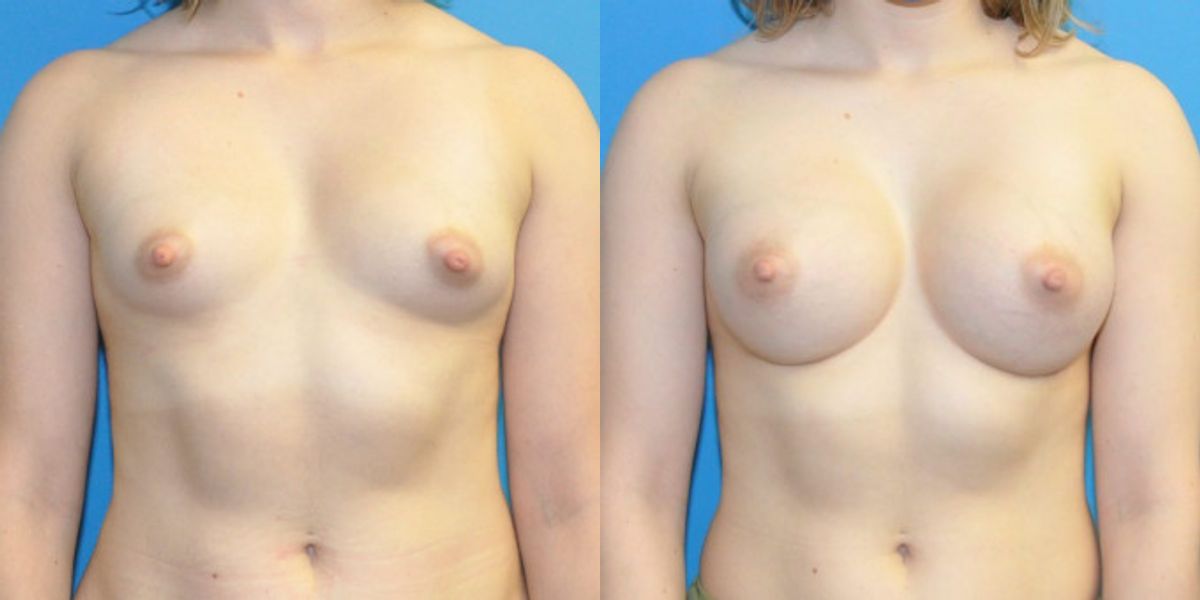 Breast Implant #120 - Before and After