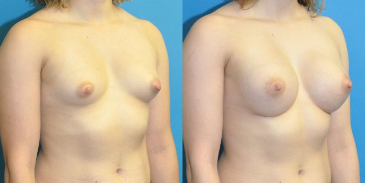 Breast Implant #120 - Before and After