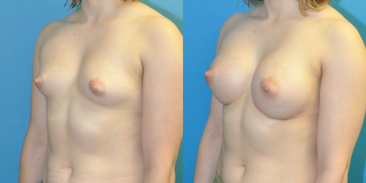 Breast Implant #120 - Before and After