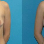 Breast Implant #121 - Before and After