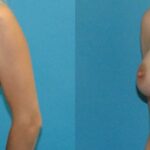Breast Implant #121 - Before and After