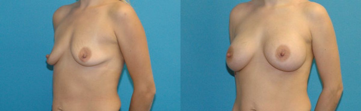 Breast Implant #121 - Before and After