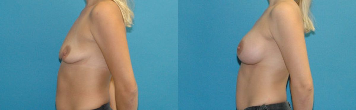Breast Implant #121 - Before and After