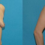 Breast Implant #121 - Before and After