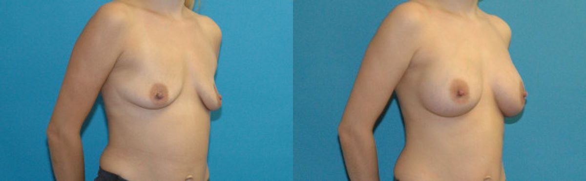 Breast Implant #121 - Before and After