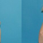 Breast Implant #121 - Before and After