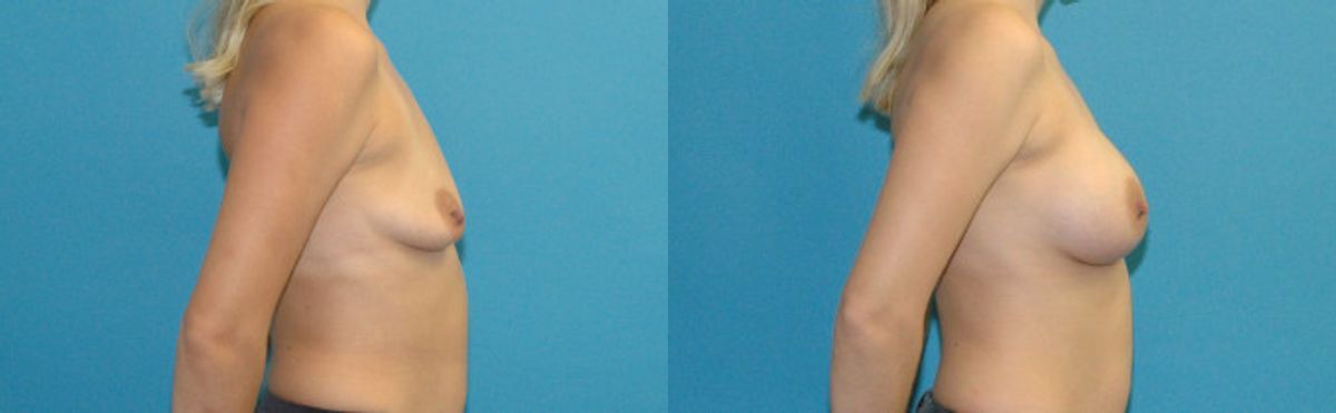 Breast Implant #121 - Before and After