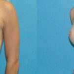 Breast Implant #122 - Before and After