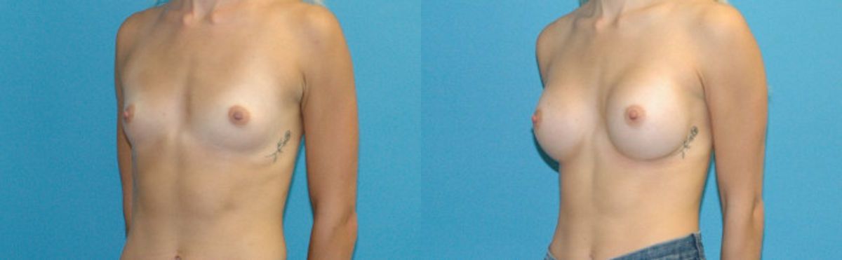 Breast Implant #122 - Before and After