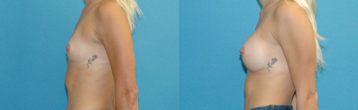 Breast Implant #122 - Before and After