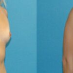 Breast Implant #122 - Before and After