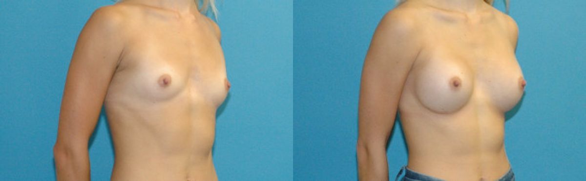 Breast Implant #122 - Before and After