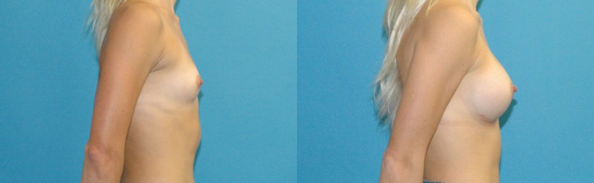Breast Implant #122 - Before and After