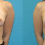 Breast Implant #123 - Before and After