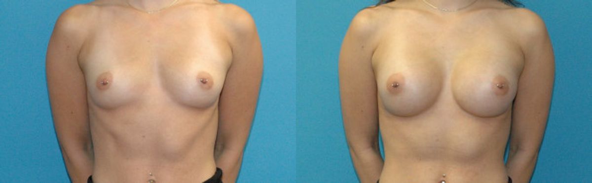 Breast Implant #123 - Before and After