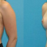 Breast Implant #123 - Before and After