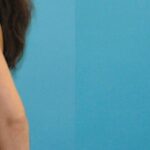 Breast Implant #123 - Before and After