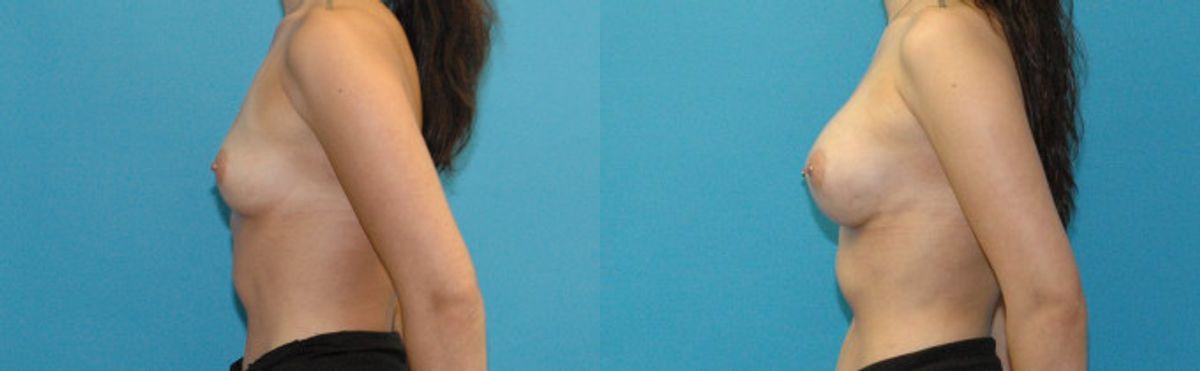 Breast Implant #123 - Before and After