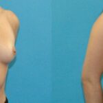 Breast Implant #123 - Before and After