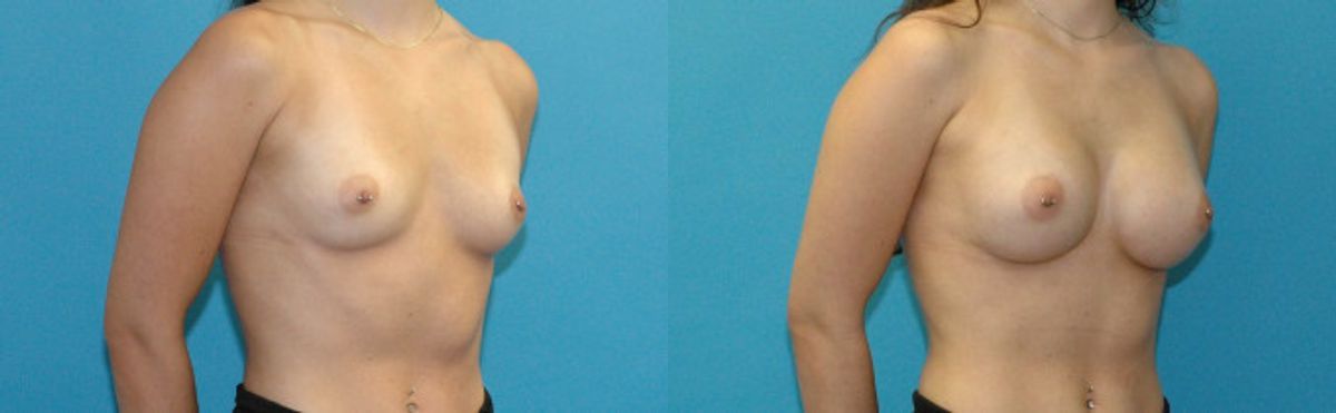 Breast Implant #123 - Before and After