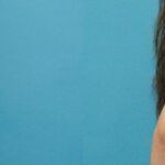 Breast Implant #123 - Before and After