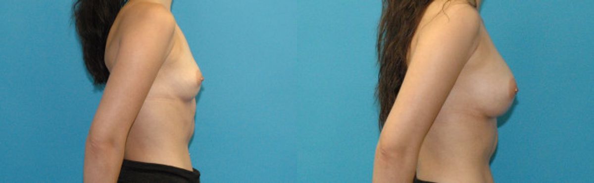 Breast Implant #123 - Before and After