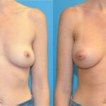 Breast Implant #124 - Before and After
