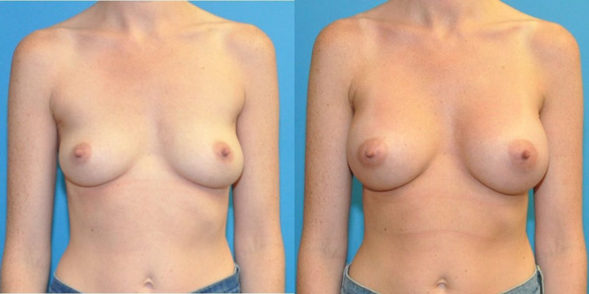 Breast Implant #124 - Before and After