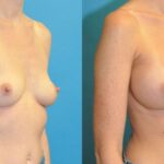 Breast Implant #124 - Before and After