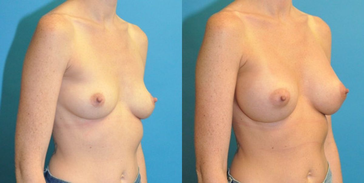 Breast Implant #124 - Before and After