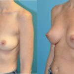 Breast Implant #124 - Before and After