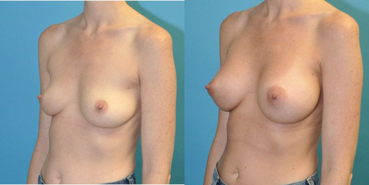 Breast Implant #124 - Before and After