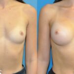 Breast Implant #125 - Before and After