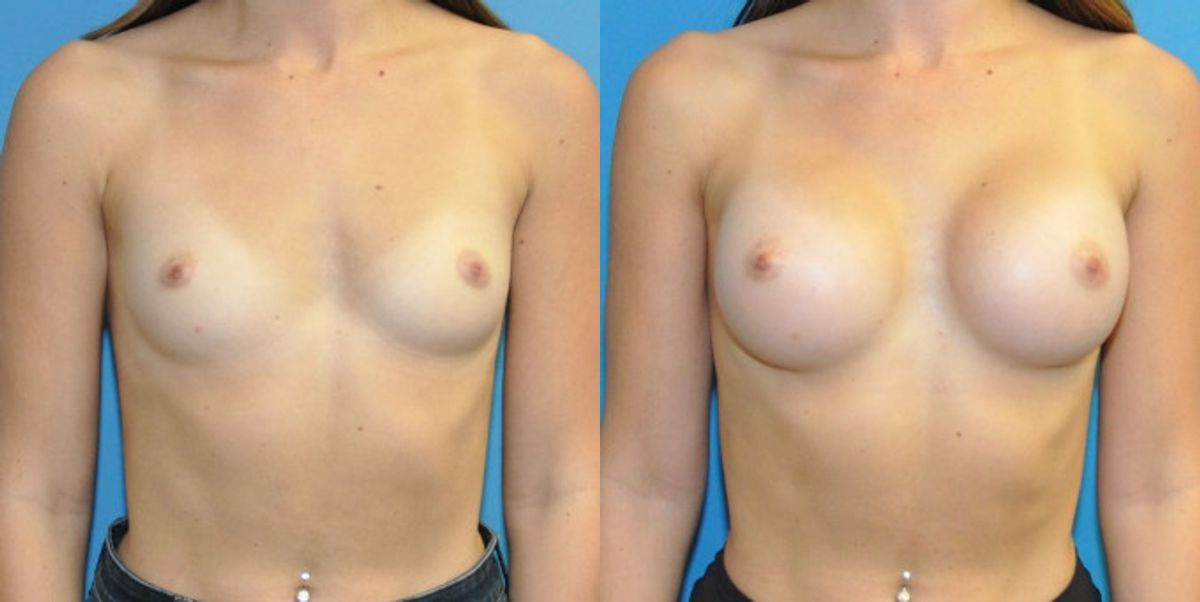 Breast Implant #125 - Before and After