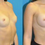 Breast Implant #125 - Before and After