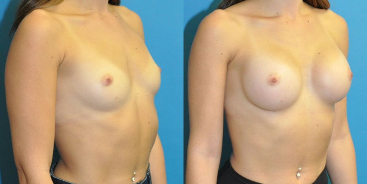 Breast Implant #125 - Before and After