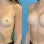 Breast Implant #125 - Before and After