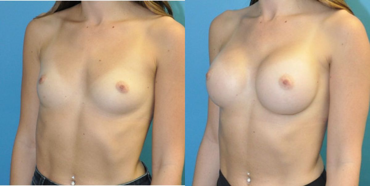 Breast Implant #125 - Before and After
