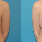 Breast Implant #126 - Before and After