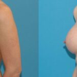 Breast Implant #126 - Before and After