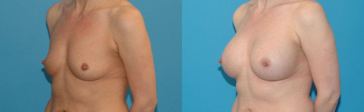 Breast Implant #126 - Before and After