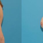 Breast Implant #126 - Before and After