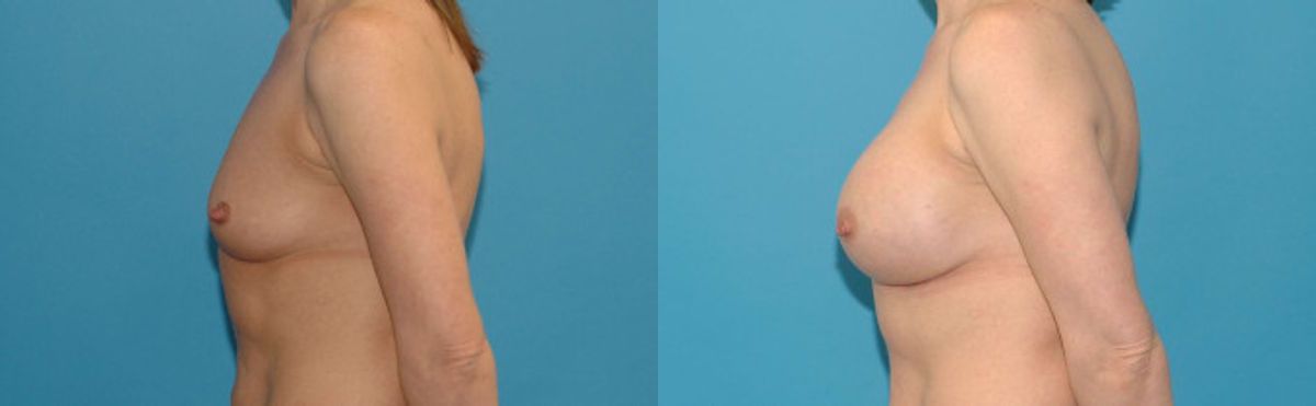 Breast Implant #126 - Before and After