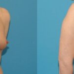 Breast Implant #126 - Before and After