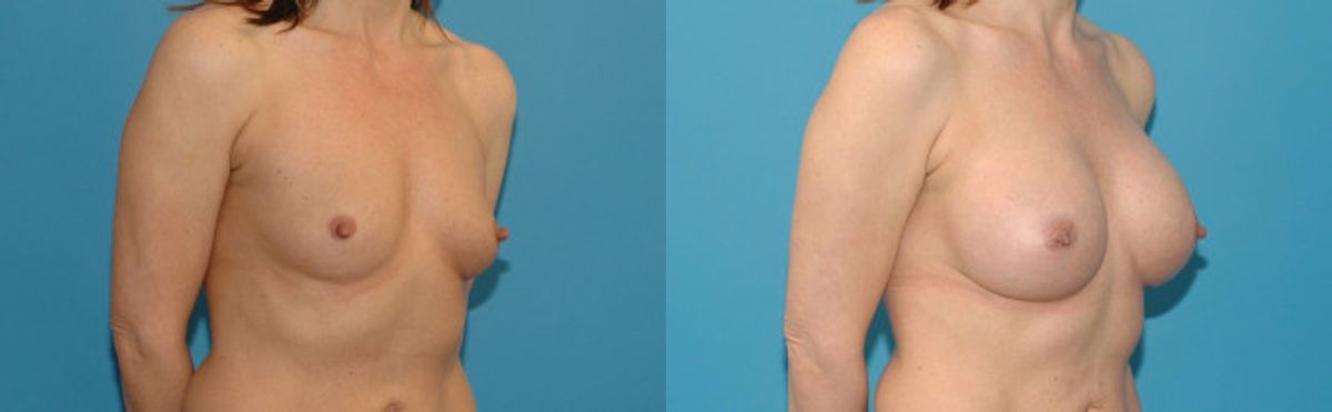 Breast Implant #126 - Before and After