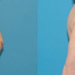 Breast Implant #126 - Before and After