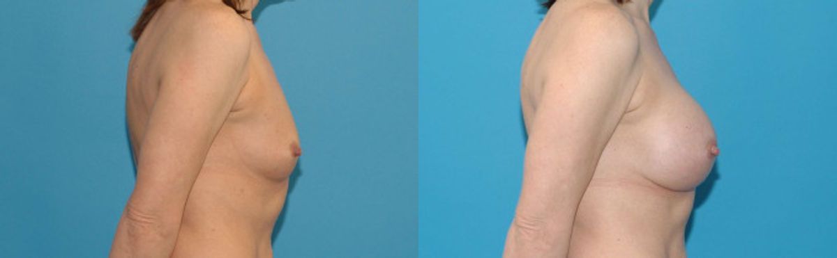 Breast Implant #126 - Before and After